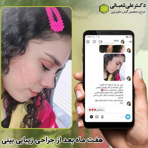 جراحی-بینی-284
