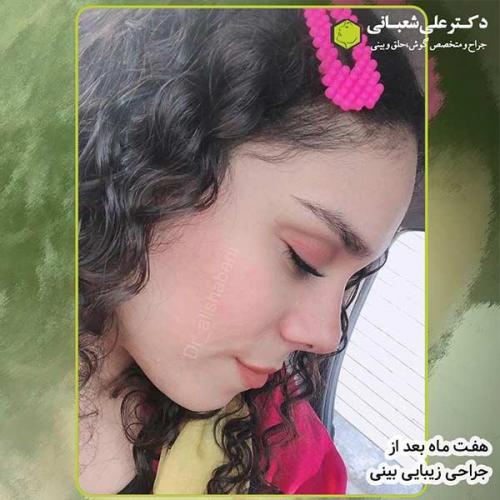 جراحی-بینی-285