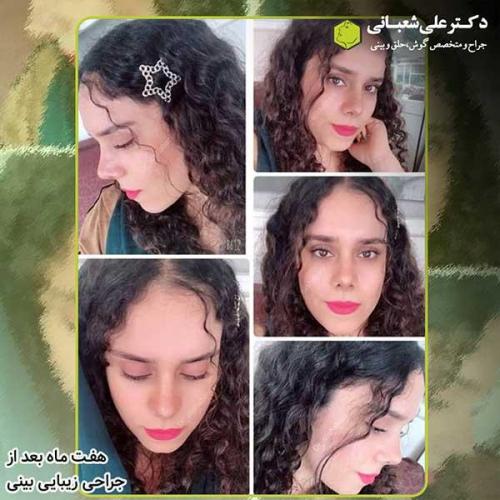 جراحی-بینی-286