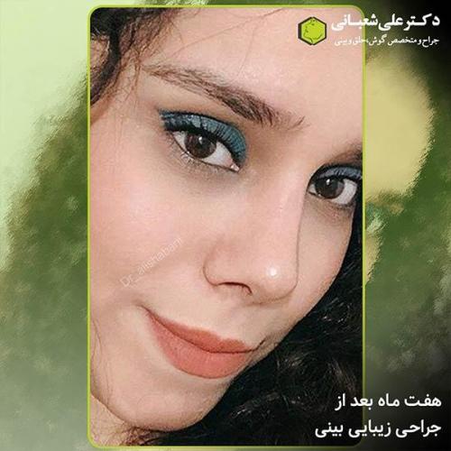 جراحی-بینی-287