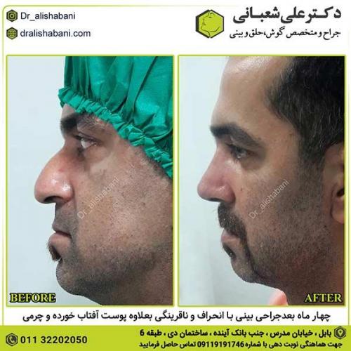 جراحی-بینی-289