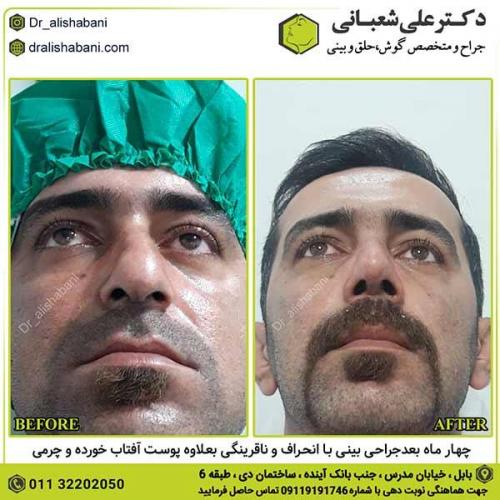 جراحی-بینی-290