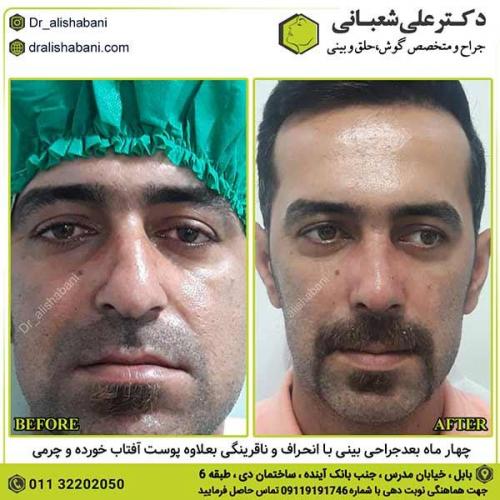 جراحی-بینی-291