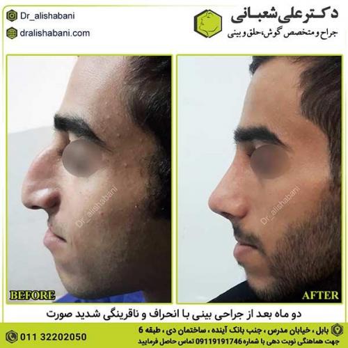 جراحی-بینی-298