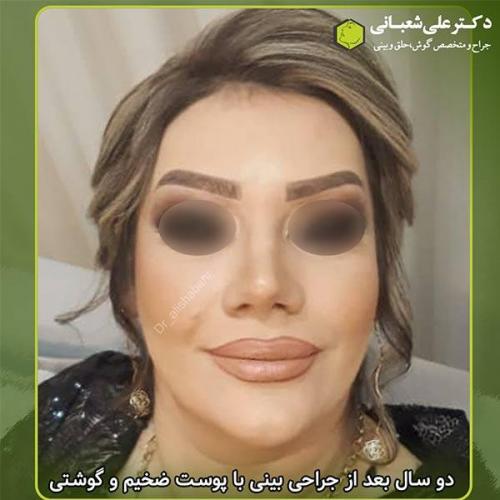 جراحی-بینی-300