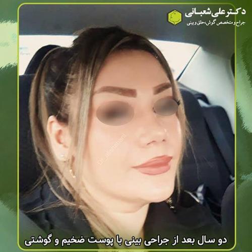 جراحی-بینی-301