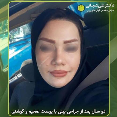 جراحی-بینی-302