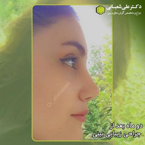 جراحی-بینی-309