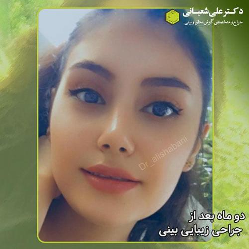 جراحی-بینی-310