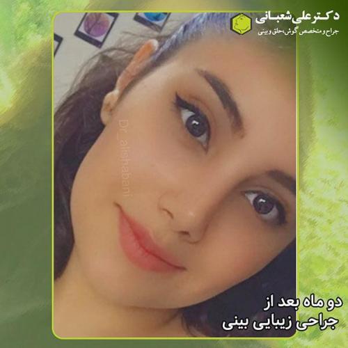 جراحی-بینی-311