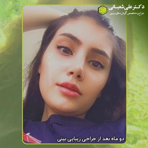 جراحی-بینی-312