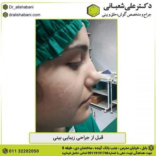 جراحی-بینی-315