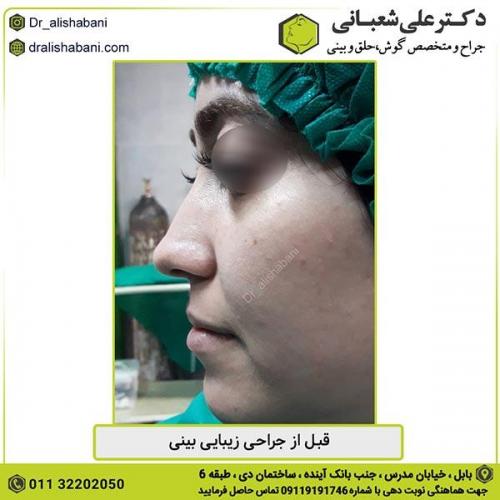 جراحی-بینی-316