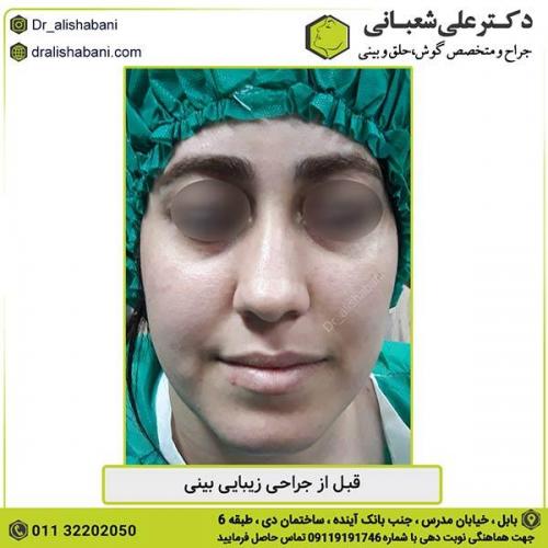 جراحی-بینی-317