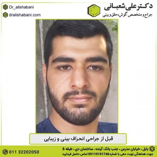 جراحی-بینی-321