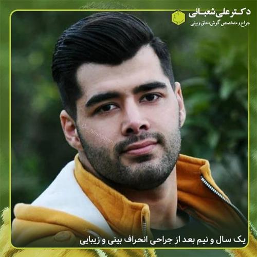 جراحی-بینی-322