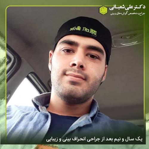 جراحی-بینی-323