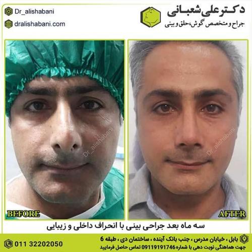 جراحی-بینی-324