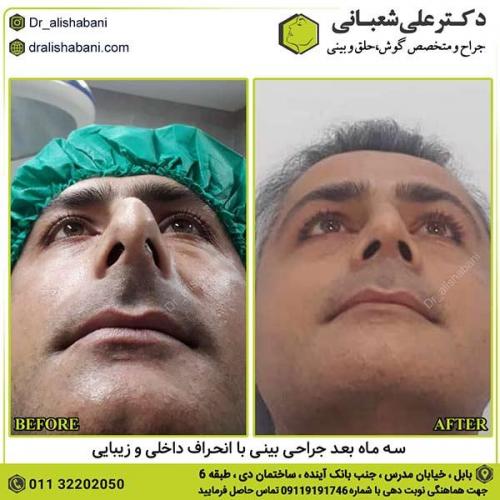 جراحی-بینی-325