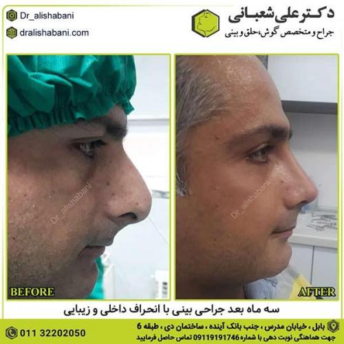 جراحی-بینی-327