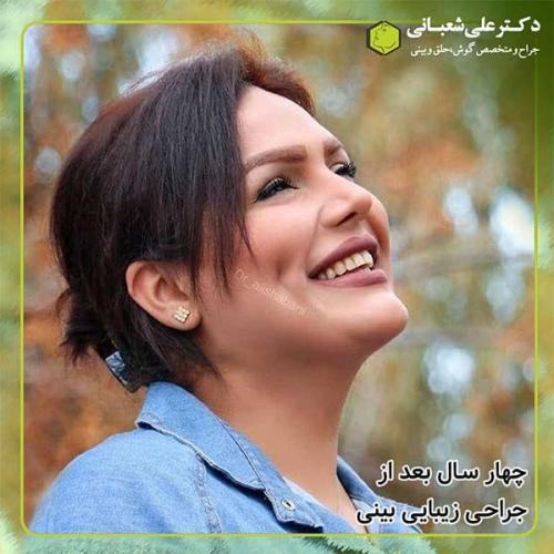 جراحی-بینی-328