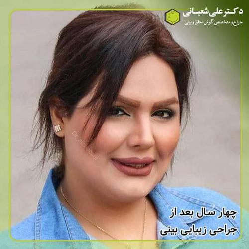 جراحی-بینی-329