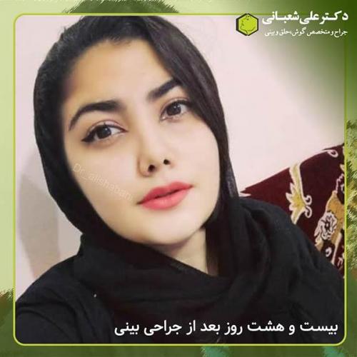 جراحی-بینی-332