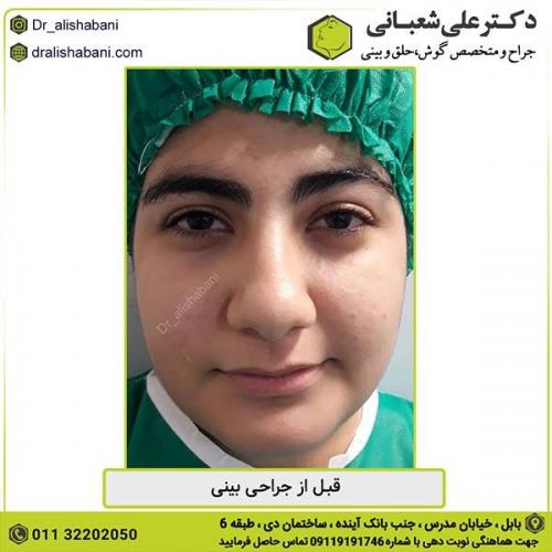 جراحی-بینی-336