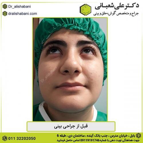 جراحی-بینی-337