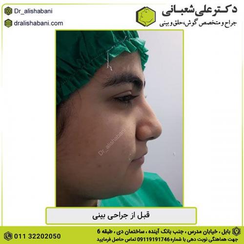 جراحی-بینی-339