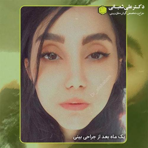 جراحی-بینی-340