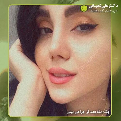 جراحی-بینی-341