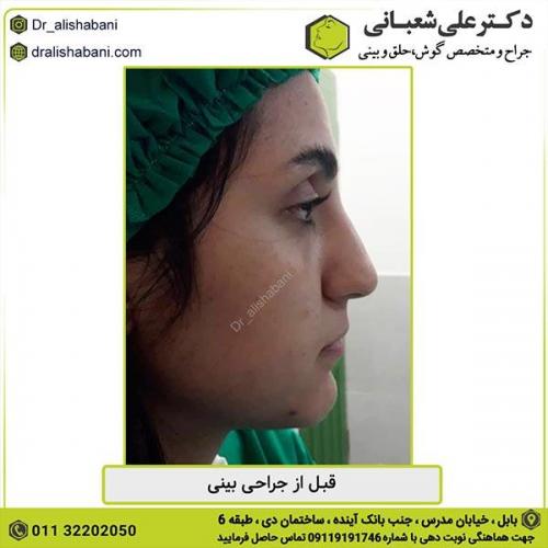 جراحی-بینی-345
