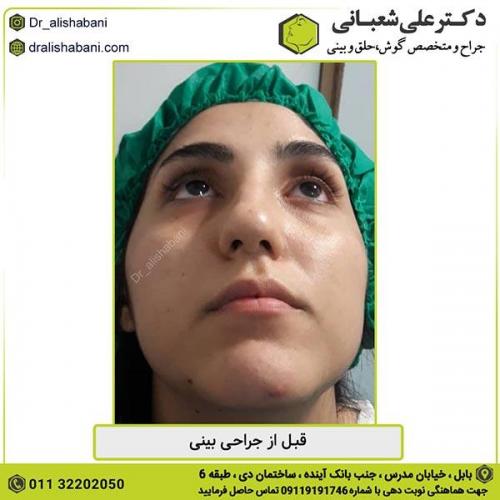 جراحی-بینی-346