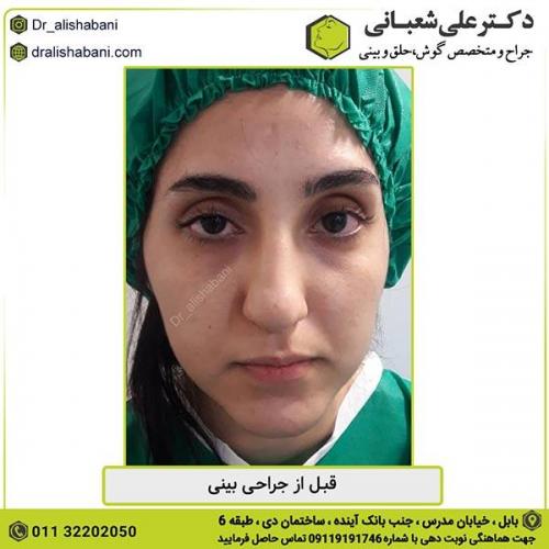 جراحی-بینی-347