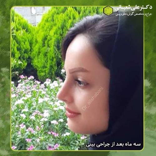 جراحی-بینی-349
