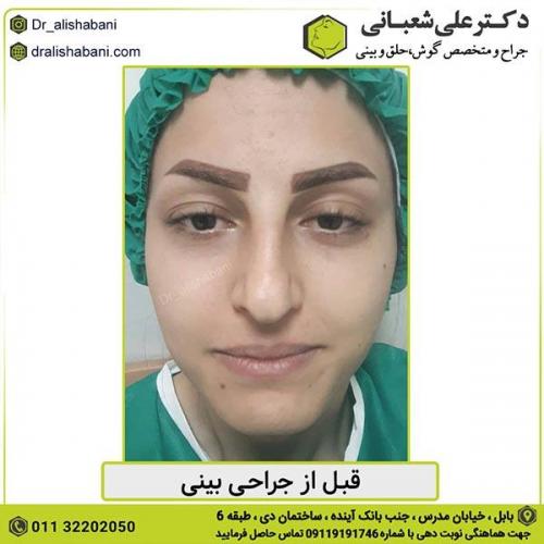 جراحی-بینی-352
