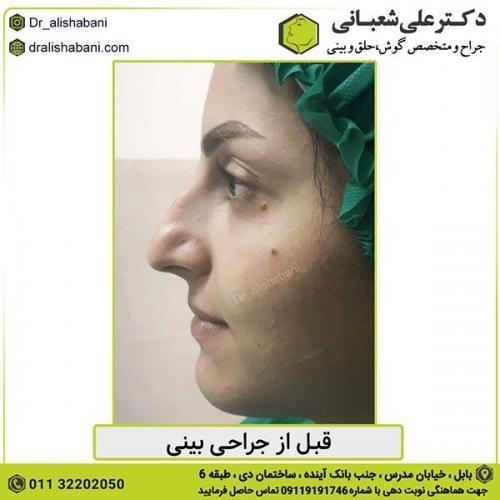جراحی-بینی-353
