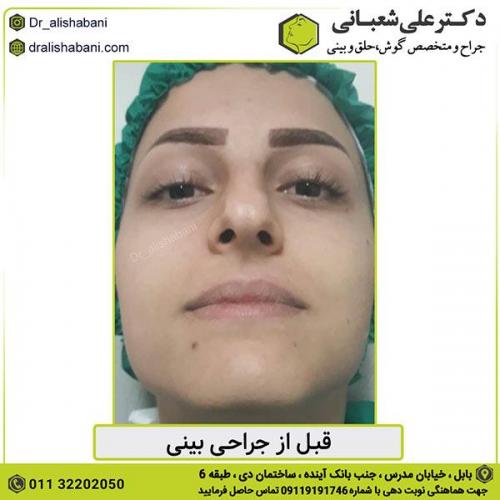 جراحی-بینی-355