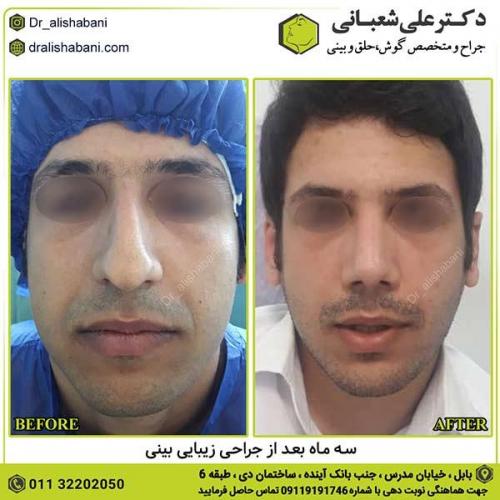 جراحی-بینی-360