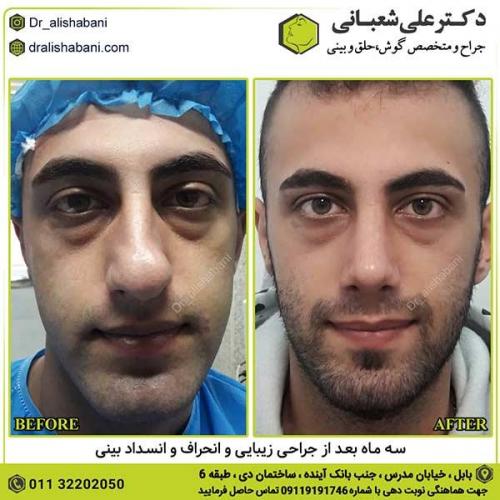 جراحی-بینی-362