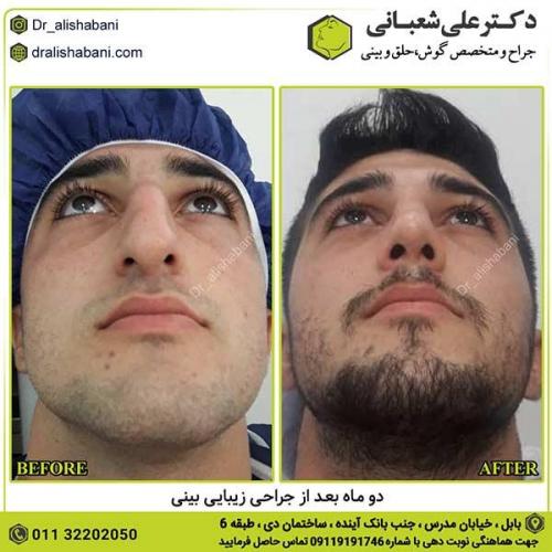 جراحی-بینی-369
