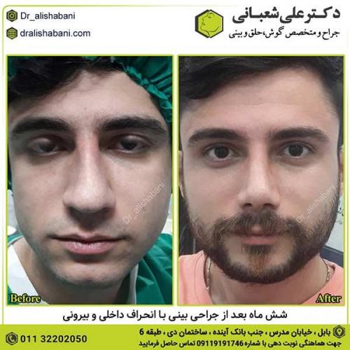 جراحی-بینی-370