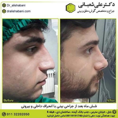 جراحی-بینی-371