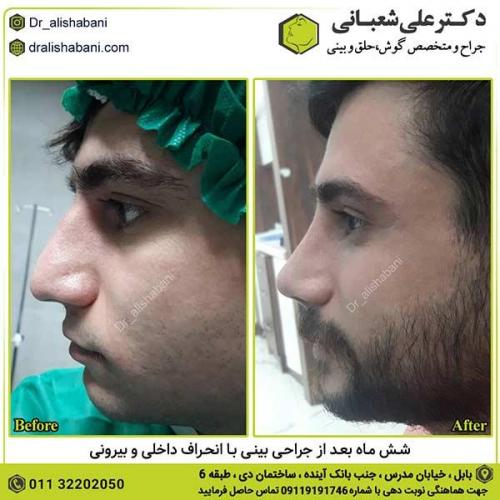 جراحی-بینی-372