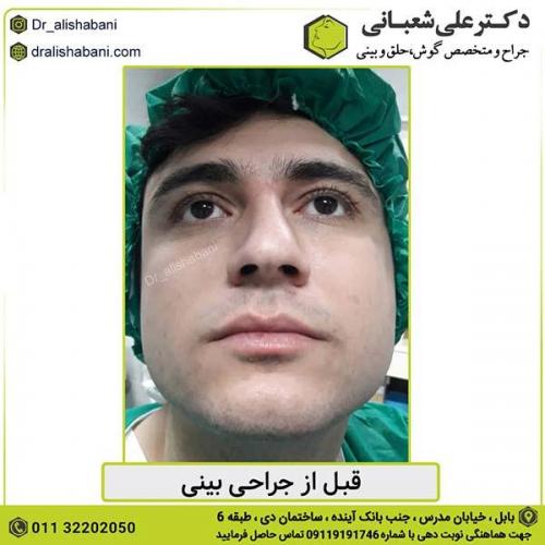 جراحی-بینی-373