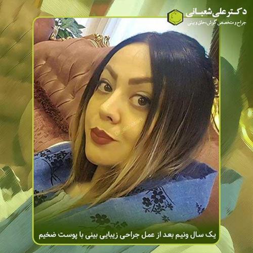 جراحی-بینی-376
