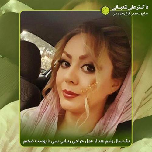 جراحی-بینی-377