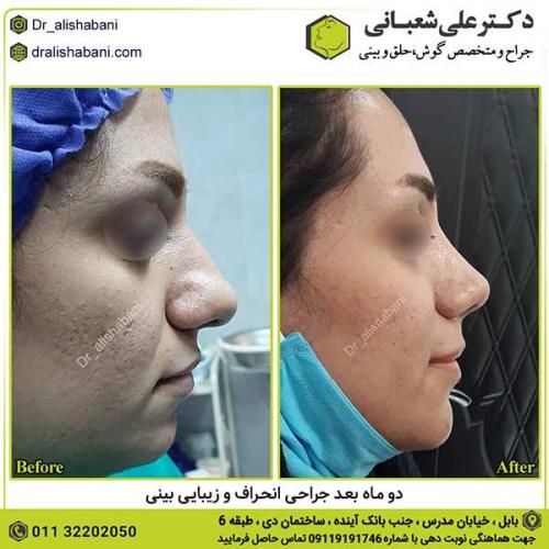 جراحی-بینی-382