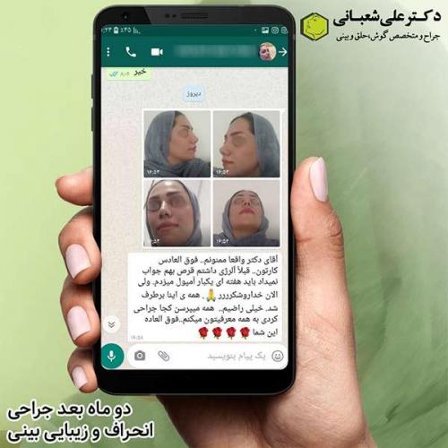 جراحی-بینی-385